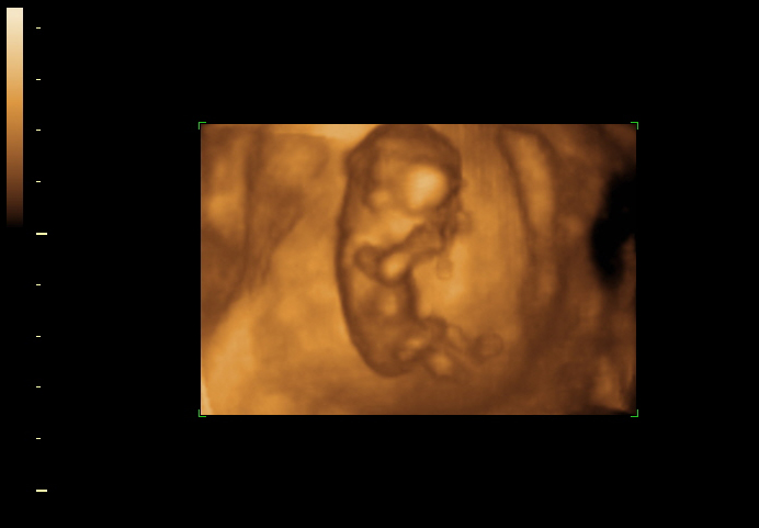 3D ultrasound image at 12 weeks